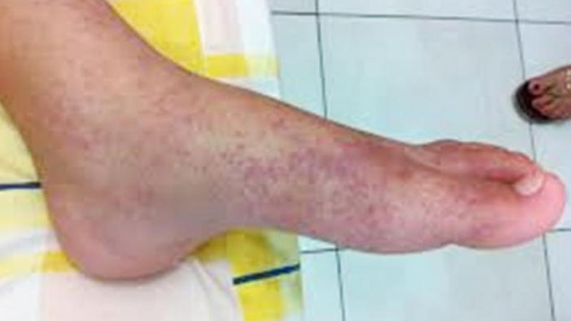 Gejala Chikungunya yang Mirip Demam Berdarah, Apa Bedanya? – PAFI Kab. Pelalawan